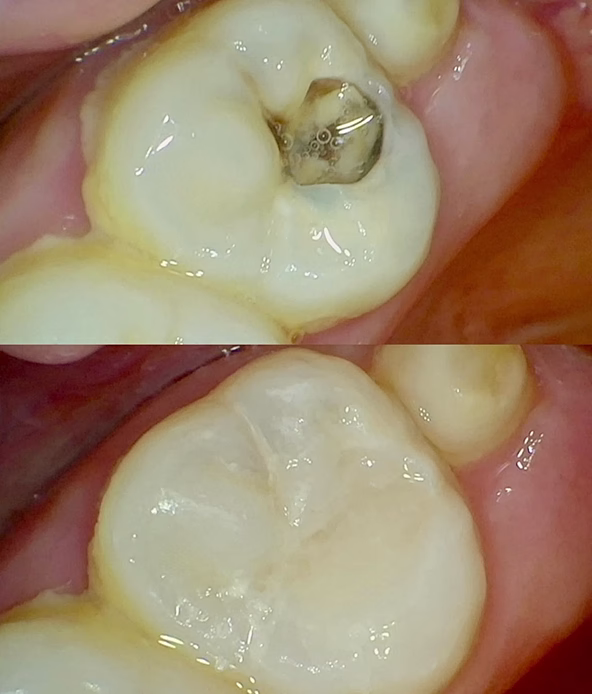 Obturație dentară înainte și după tratamentul unei carii