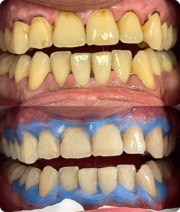Albire dentara inainte si dupa pentru imbunatatirea culorii dintilor