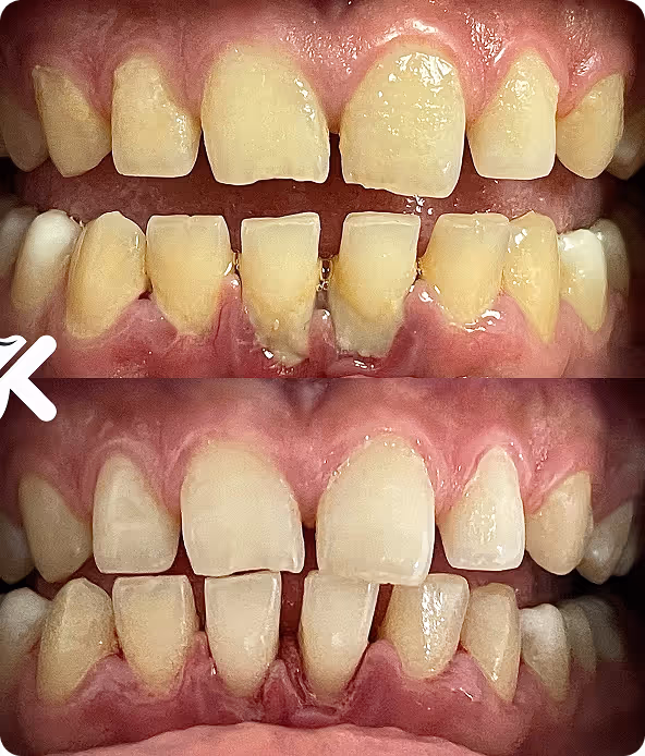 Igienizare dentară profesională înainte și după detartraj și periaj