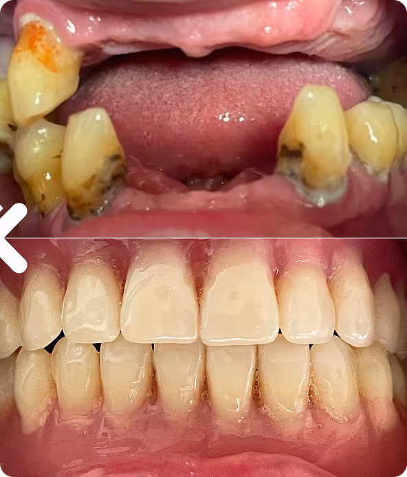 Proteză dentară totală înainte și după restaurarea zâmbetului