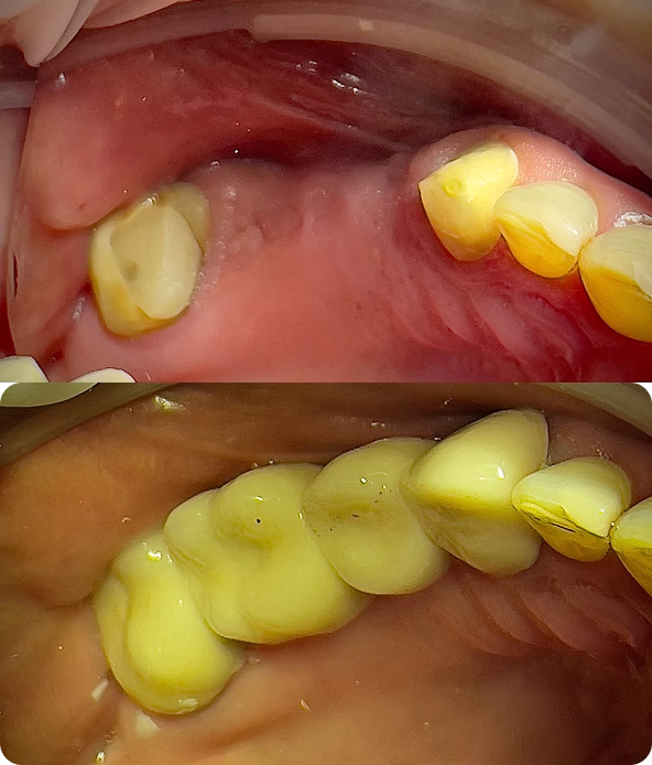Punte dentară metalo ceramica pentru refacerea dintilor lipsa
