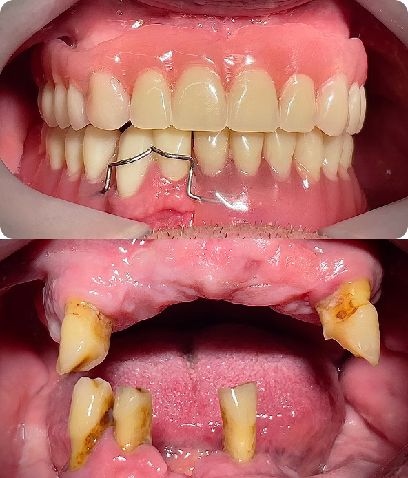 Reconstrucție dentară totală înainte și după tratament